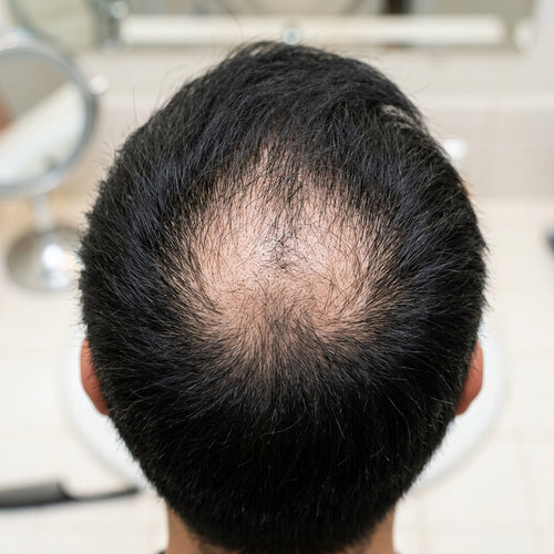 Hombre revisando su cabello fino y con entradas antes de usar el densificador capilar